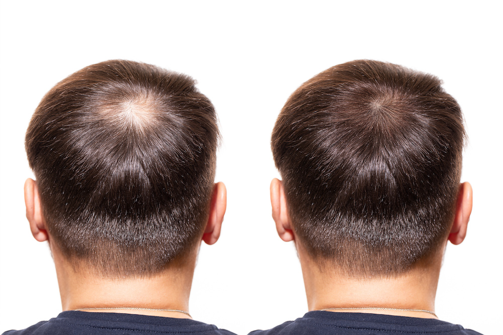 Hair loss. Men view from the back, comparison of hair before and after transplantation. bald head. baldness treatment. Medicine. thick healthy hair. head. people - problem hair, white background